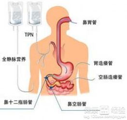 急性重症胰腺炎恢复期的饮食