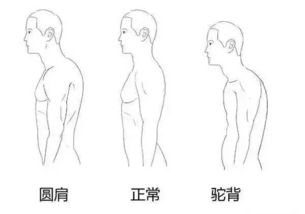 圆肩驼背型背厚,该怎么矫正