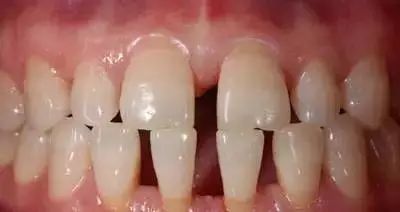 牙缝大能补吗，牙齿有缝隙可以补吗牙齿缝隙大能补吗