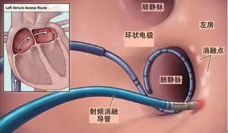 心脏导管射频消融术,术前术后讲解都在这里了 