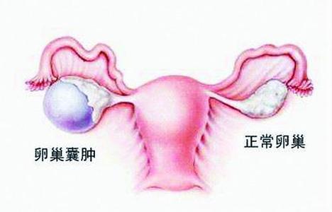 囊肿吃什么食物能减小 医生 囊肿的部位,决定了处理方式