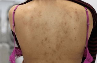 背部疤痕的3种症状表现