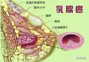 乳腺结节感觉不到疼痛就是良性的吗 真相远没有这么简单 视频