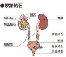 尿结石怎么预防呢