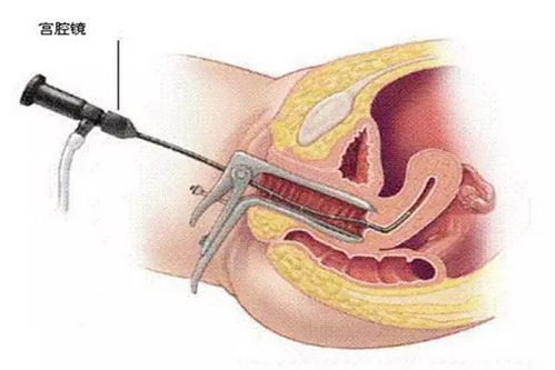 宫腔镜取残留风险大不大(宫腔镜取残留手术危险吗)