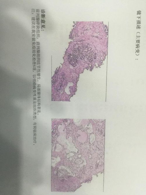 是前列腺癌吗 免疫组化6项,跪求 