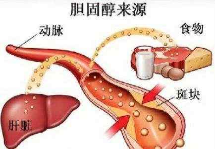 杨明杰医生解密预防动脉硬化的六大误区