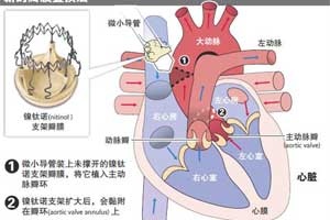 无缝线瓣膜置换术