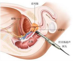 前列腺癌能传染人吗