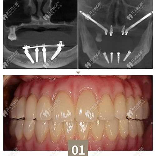 案例分享 牙槽骨严重萎缩顾客的福音 穿颧种植手术