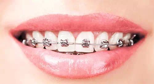 正畸治疗是否对牙周的健康造成危险