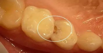 一颗蛀牙被 的过程