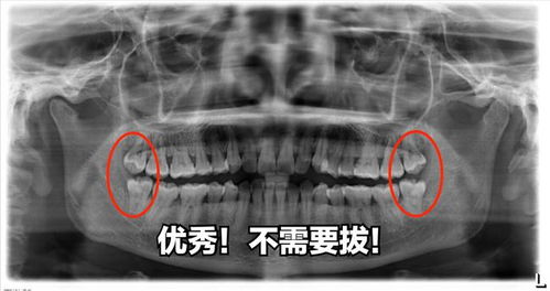 为啥智齿不疼也要拔 拔牙注意点 费用,最全攻略,建议收藏