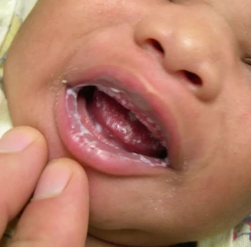 新生儿嘴里长白毛 月嫂说宝宝这是得鹅口疮了,防治宝宝口腔细菌应这么做