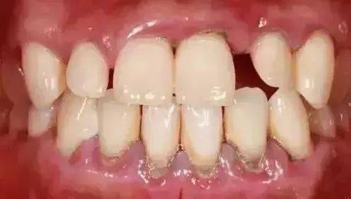 为什么医生让我,洗牙,洗牙,赶紧洗牙 牙龈 口腔 牙齿 
