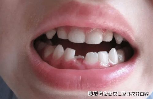 换牙期的烦恼 换牙后,萌萌的小乳牙变成大板牙是为什么 该怎么办