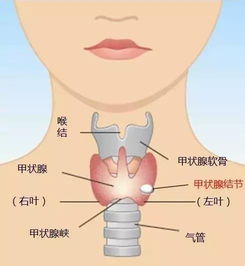 没有结节也可能是甲状腺癌 做好这七点远离甲状腺疾病