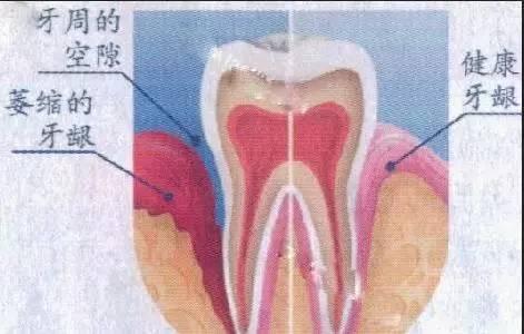 牙齿看来变长了 原来是牙龈萎缩