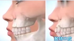 龅牙,牙齿前凸矫正过程演示
