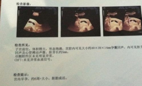 原创孕中期，“唐筛”检查可能有这3个“小秘密”，为了胎宝了解下