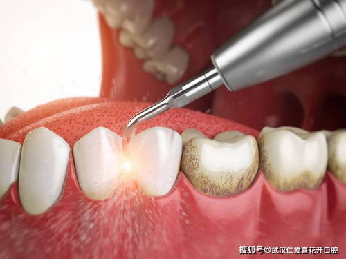 用手抠掉牙结石 医生劝你住手,用绝佳方法清除难道不香吗