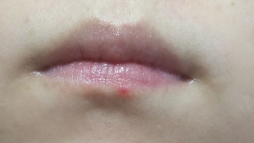 我的下嘴唇下有个红痘,这是怎么啦 