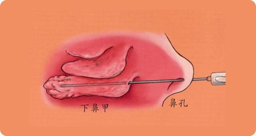 鼻甲肥大如何治疗 什么原因会导致鼻甲肥大