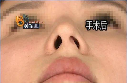 隆鼻术后为何会出现鼻孔不对称