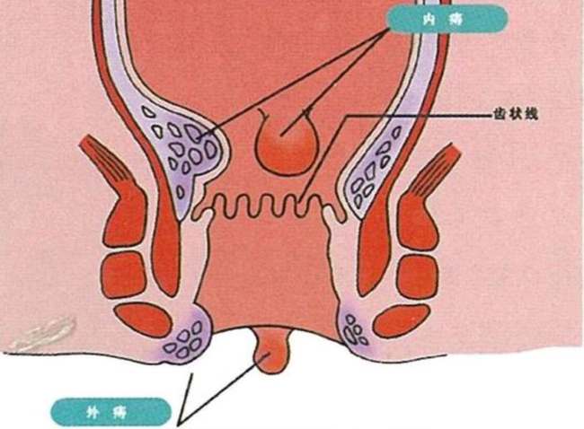 我们在日常生活中,应该如何预防痔疮