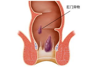 肛门有异物会有哪些危害 