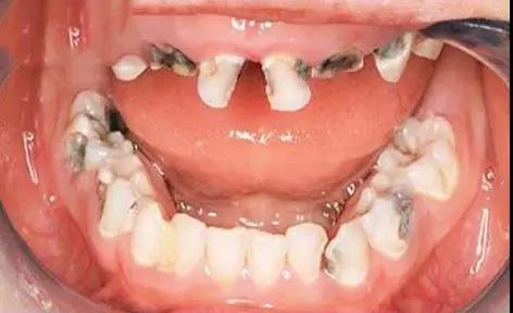 你家的孩子有蛀牙吗 记住啦 这几个预防措施要做好