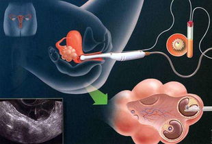 如何取卵子 试管婴儿取精子和卵子的方法