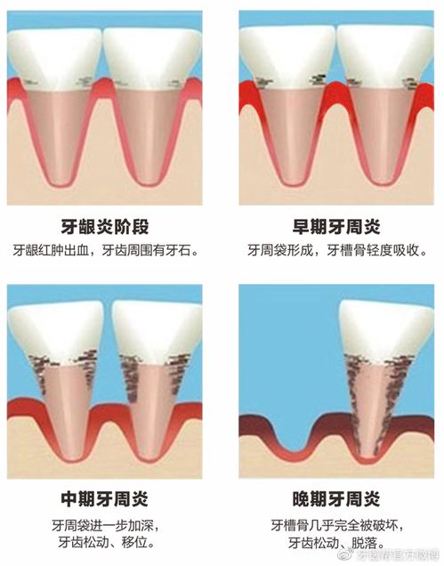 30多岁的小伙子因牙齿松动就诊,结果全口牙齿都要拔掉