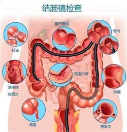 怀疑自己得了肠癌 看看是否有如下四个征兆