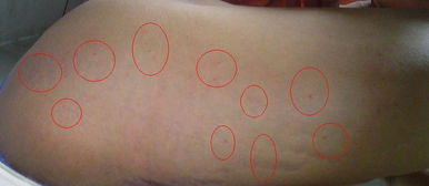 男生器官上有小红点点是不是病毒,分辨尖锐湿疣和生殖器疱疹很麻烦？4点相似，4点不同，看完你就懂