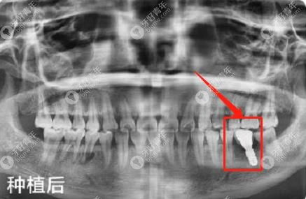 后磨牙掉了一颗怎么办,来武汉仁爱口腔做韩国奥齿泰种植牙