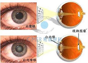 为什么用眼药水治不好白内障 