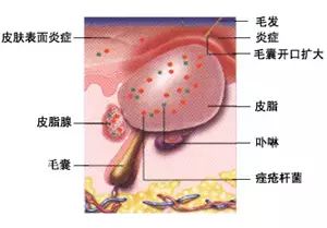 暑假季,清痘季,莫让痘痘拉低你的高颜值