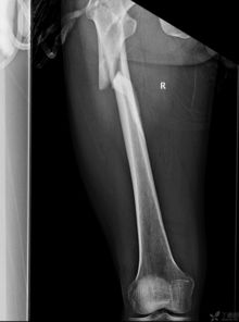 一例复杂股骨上段骨折手术内固定治疗,欢迎拍砖