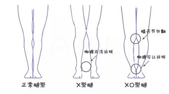 x型腿 如何预防孩子X型腿和O型腿？ 