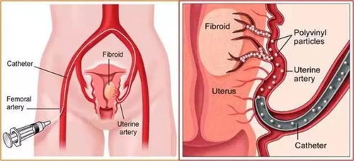 子宫肌瘤还开刀 来了解下不用开刀的微创介入治疗吧