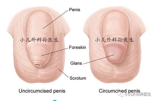 Dr.SUN 小儿包皮环切到底有没有好处