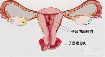 子宫内膜息肉的危害 