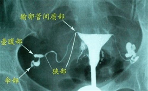 没有试管前,做输卵管造影需要注意哪些