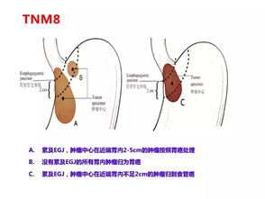 AJCC胃癌第8版TNM分期翻译及解读 