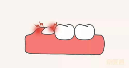 京医通 智齿不痛要拔吗 听听牙科专家怎么说