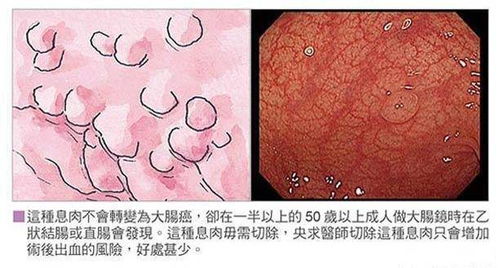 息肉有这几种,哪些需要切除 切除后还要注意什么