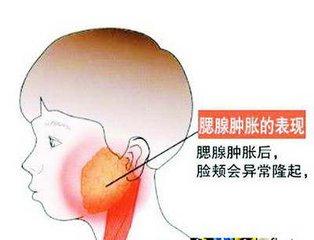 痄腮 常在幼儿园和学校流行 专家提示你咋预防 