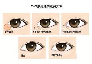 眼型美学标准告诉你为什么双眼皮和开眼角最好一起做