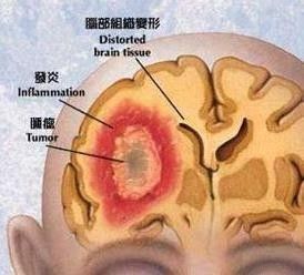 就医搜 感冒会引发脑膜炎吗 如何区分感冒与脑膜炎 